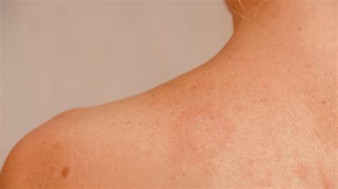 Pityriasis Rosea Treatment Causes Diagnosis Homeopath