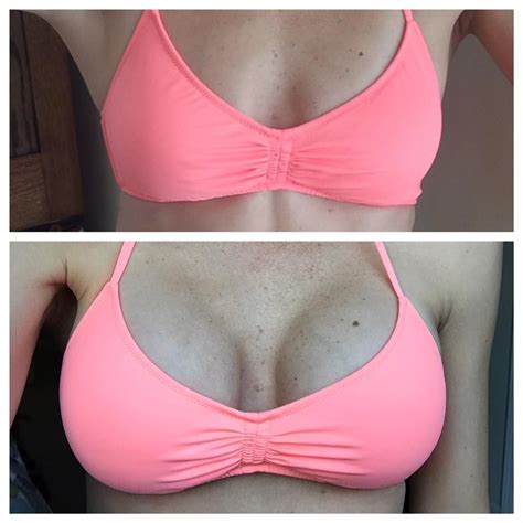 Collection Pictures Breast Augmentation Surgery Pictures Excellent