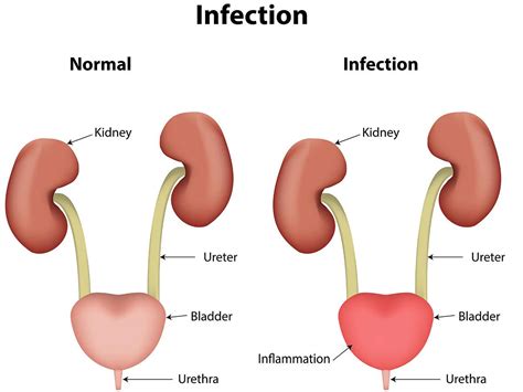 Can Kidney Cancer Cause Urinary Tract Infections Cancerwalls