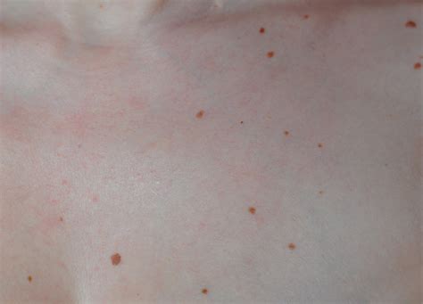 Photos Of Moles On Chest And Back How To Remove Moles Warts Skin