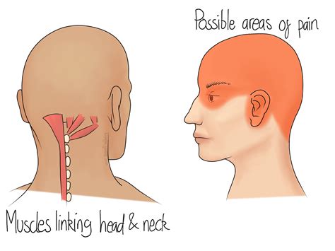 Cervicogenic Headaches Ilminster Osteopathy