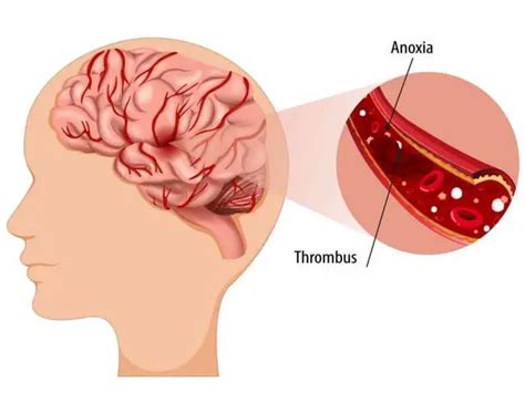 Blood Clot In Brain Reason Causes Symptoms Treatment
