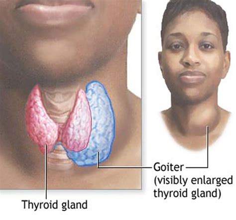 Goiteriodine History 3 Thyroid Center Of Santa Monica