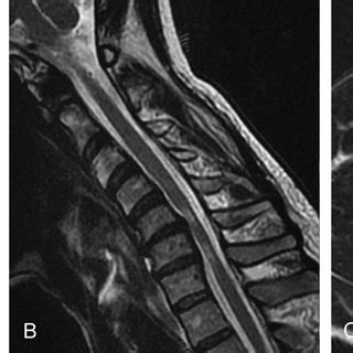 Sagittal And Axial Cervical Spine MRI A Sagittal Image At The Neutral