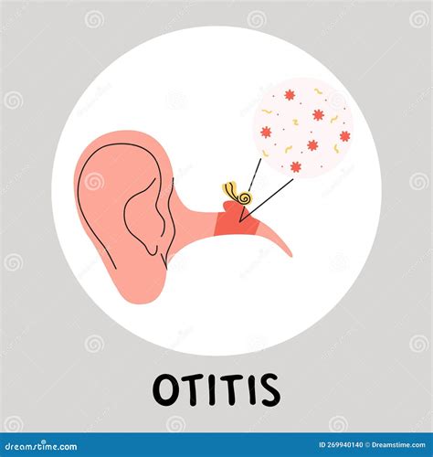 Otitis Media Flat Vector Medically Illustration Earache Becouse Of