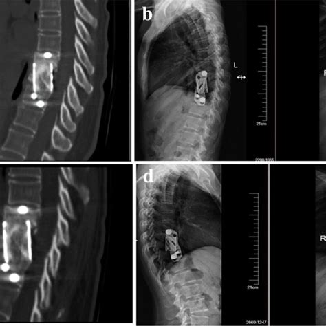 A Patient With Thoracic Spinal Tuberculosis At T78 Received Digital Download Scientific