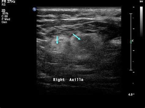 Swollen Lymph Nodes Armpit Ultrasound