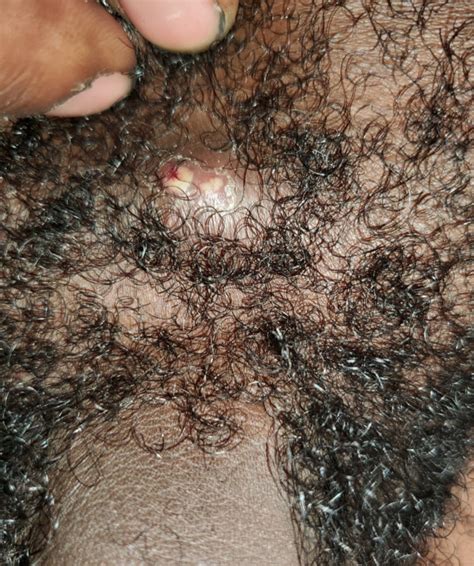 So, what then causes ingrown penile hair? Herpes or ingrown hair? Concerned. | Genital Herpes ...