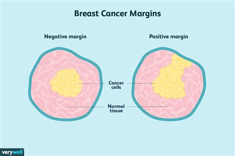 Breast Cancer Cells Vs Normal Cells