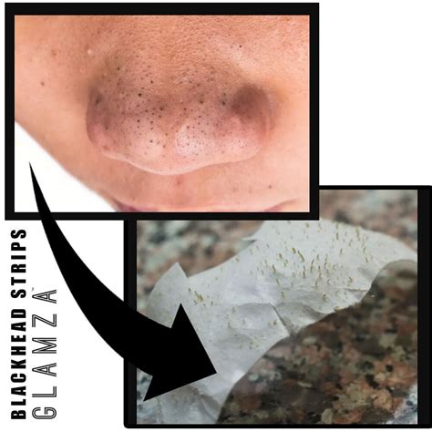 Blackhead Removal Strips Nose Face Mask Deep Cleansing Pore Treatment