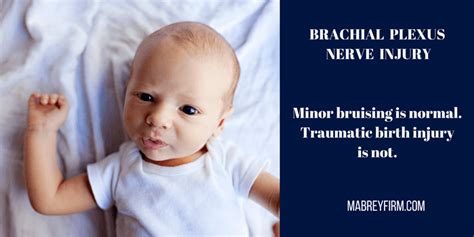 Traumatic Birth Injuries Brachial Plexus Injuries