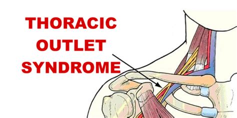 Thoracic Outlet Syndrome As Related To Heart And Circulation Pictures