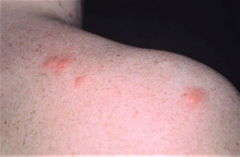 Mosquito Bites Allergy And Treatment How To Get Rid Of Mosquito Bites