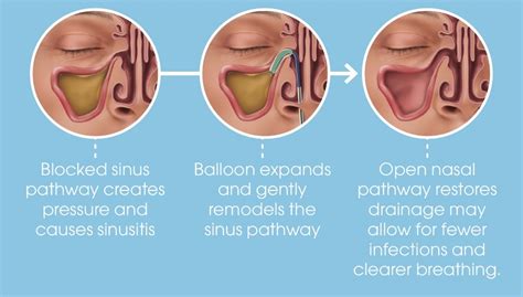 Balloon Sinuplasty —