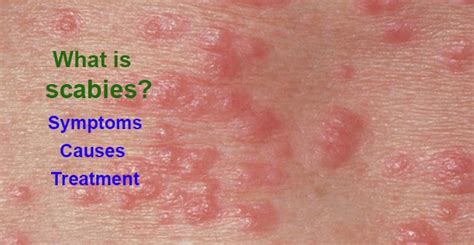 What Is Scabies Symptoms Causes Treatment And Home Remedies