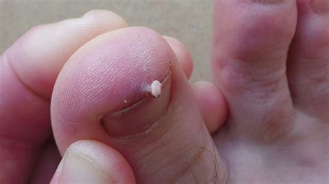 Not For The Squeamish Update On Sams Toe Parasite Gap Year After Sixty