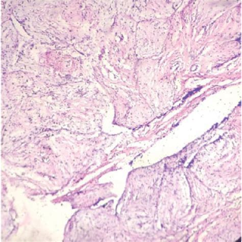Histopathology Of Phyllodes Tumour Of The Patient H And E X 80