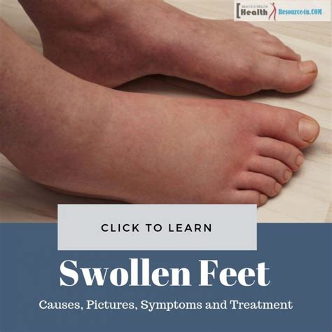 Swollen Feet Causes Pictures Symptoms And Treatment Swollen Feet My Xxx Hot Girl