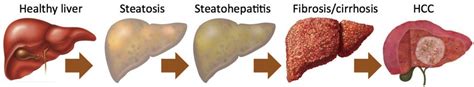 Nonalcoholic Fatty Liver Disease Concise Medical Knowledge