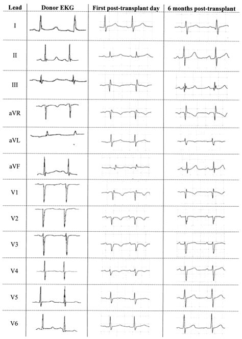 Electrocardiographic Changes Simulating A Myocardial Infarction After