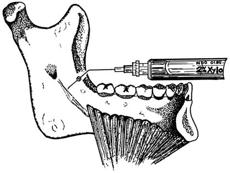 Anesthetic Efficacy Of The Mylohyoid Nerve Block And Combination