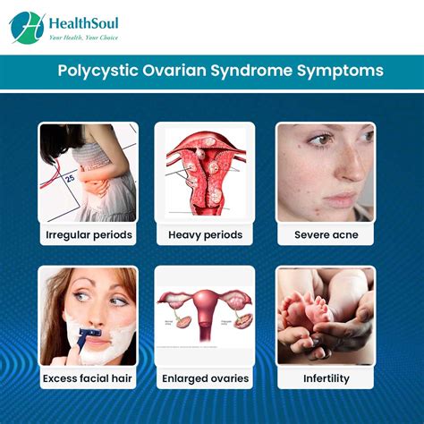Polycystic Ovarian Syndrome A Treatable Cause Of Infertility Healthsoul
