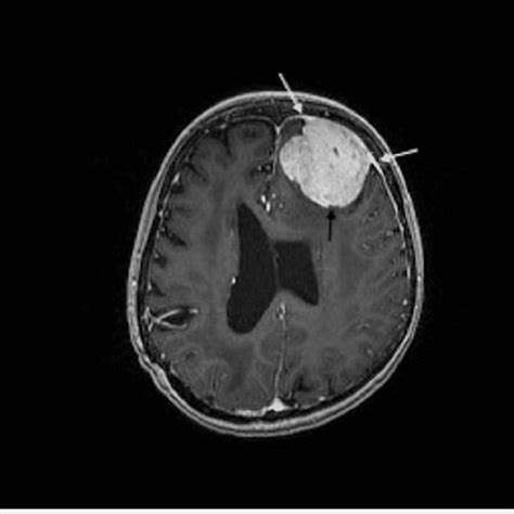 A T1 Weighted Post Gadolinium Axial Mri Showing A 25cm Homogeneously
