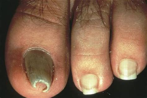 Nail Diseases And Disorders Pictures Photos