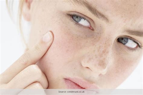 Treatment For Dry Skin Acne How To Protect Acne Prone Skin