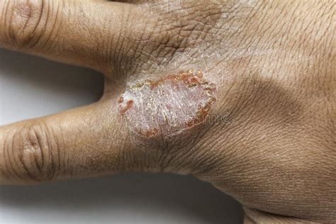 Seborrheic Dermatitis On Fingers Atopic Dermatitis Symptoms Images