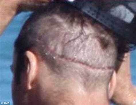 However, her hair suffered due to years of hair extensions, and she now has bald spots. JEREMY PIVEN has definitely had at least one hair ...