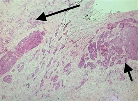 The Histopathology Slide With The Adenocarcinoma Labelled Using The