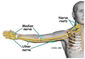 Pinched Nerve Treatment Neck And Arm Pain Therapy