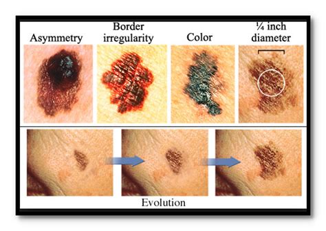 How Does Skin Cancer Start Cancer And Cancer Treatment