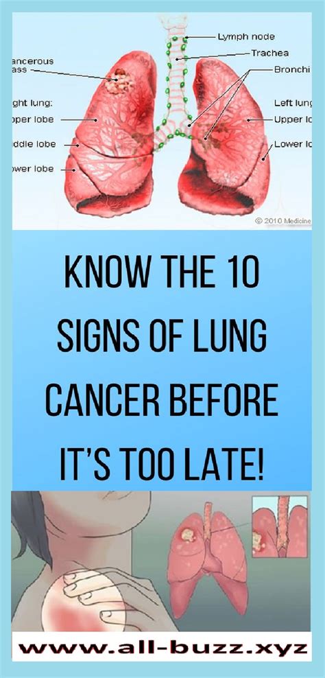 What are lung cancer's symptoms, how is it treated, is coughing a sign and what are the different stages? Be Aware Of These Symptoms For Possible Lung Cancer
