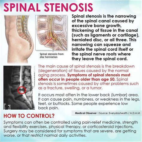 Here Is An Explanation Of Spinal Stenosis Spinal Stenosis Stenosis