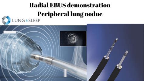 Radial Endobronchial Ultrasound Ebus Bronchoscopy Demonstration Of