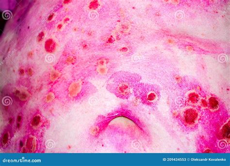 Discoid Rash Of System Lupus Eruthematosus Stock Image Image Of Belly