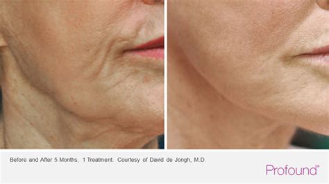 Profound Facial Treatment Before And After Arlington Dc Metro