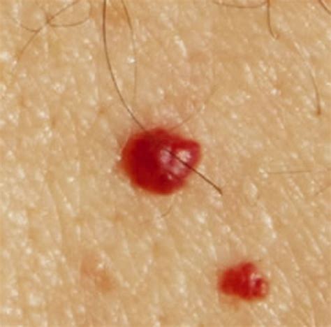 Red Skin Moles Pictures Photos