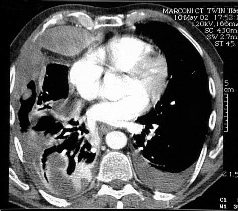 Thoracic Ct Scan Showing The Bilateral Hemothorax Download