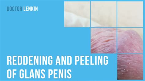 😟 Reddening And Peeling Of Glans Penis And Foreskin Youtube