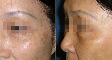 Sun Spots Age Spots Melasma Laser Treatments Skincare Prescription