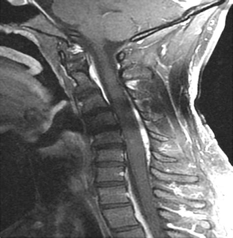 MRI Cervical Spine Without Contrast Shows An Abnormal Hypointense Download Scientific Diagram
