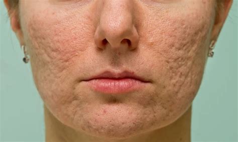 Rolling Acne Scars Causes And Solutions Celevenus Wellness