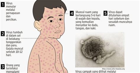 Virus penyebab campak bernama paramyxovirus. Dokter GO: Berbagai Gejala pada penyakit Campak/ Rubeola ...