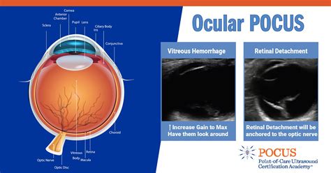 Ocular Pocus Pocus Resources And Case Studies