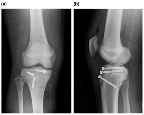 Medicina Free Full Text Type V Tibial Tubercle Avulsion Fracture With Suspected Complication