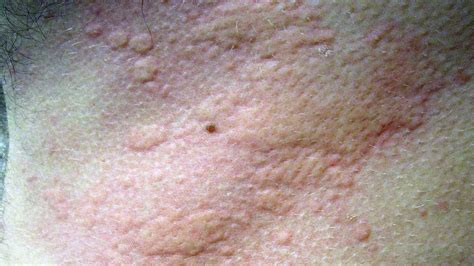 Is It Hives Or Psoriasis Learn The Signs Alergi Kulit