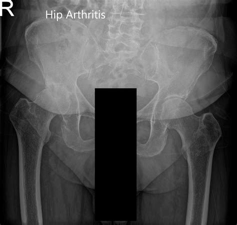 Case Study Right Total Hip Replacement In 75 Year Old Female Ny Usa